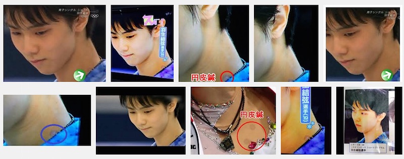 羽生結弦選手と円皮鍼